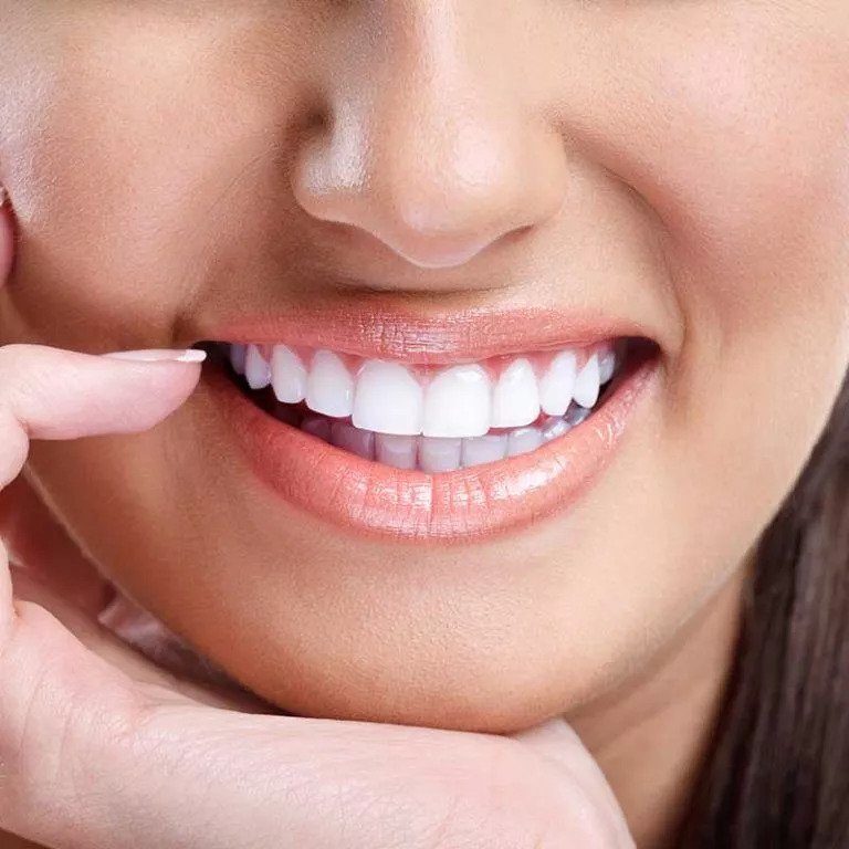 Dental Veneers Dubai